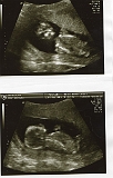 2nd Ultrasound 02